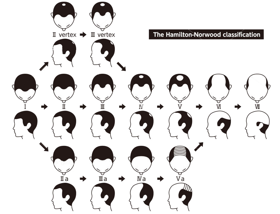 初期の薄毛(AGA)パターン別写真